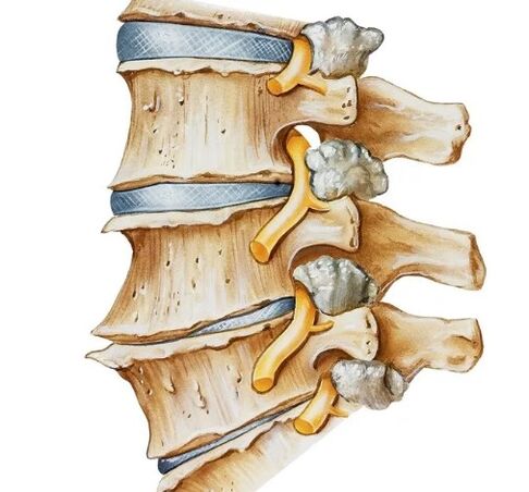 Pinching do nervio na columna vertebral
