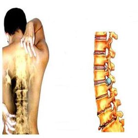 Etapas da osteocondrose