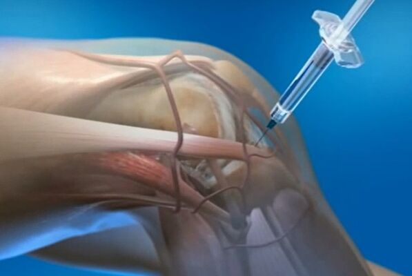 inxeccións intra -articulares para artrose da articulación do xeonllo