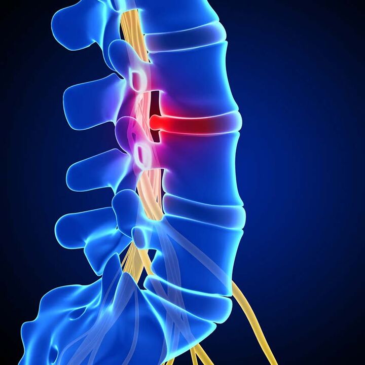 Protrusión do disco intervertebral na canle espinal resultante da osteocondrose da columna lumbar