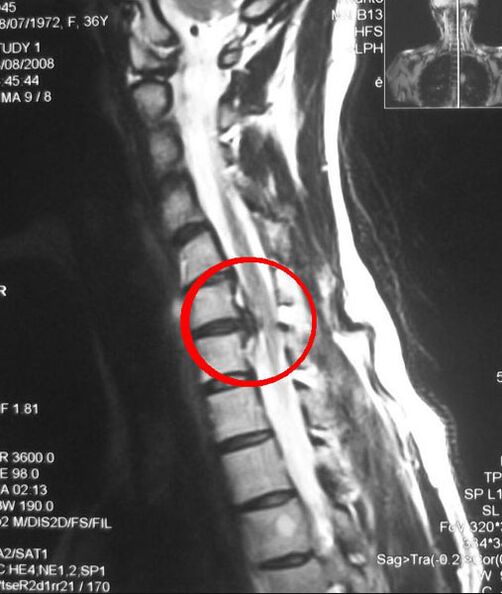 Síntomas de osteocondrose torácica nunha radiografía